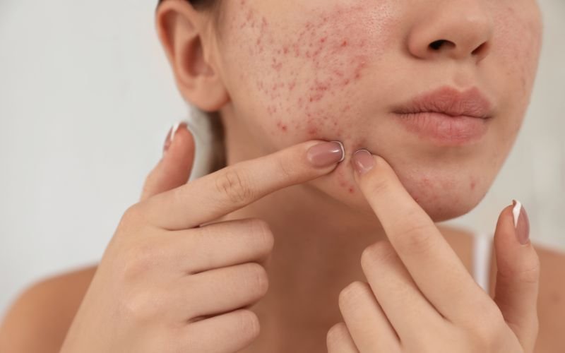 Understanding Acne: Causes, Treatment Options & Everyday Care